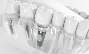 Отзыв об имплантации зубов
